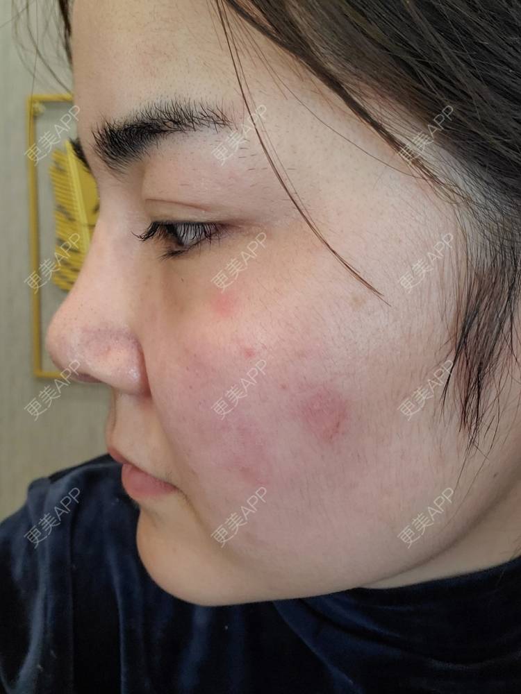 更美 - 夏天盛开的向日葵的硅胶隆鼻经验 | 硅胶隆鼻 | 郑州