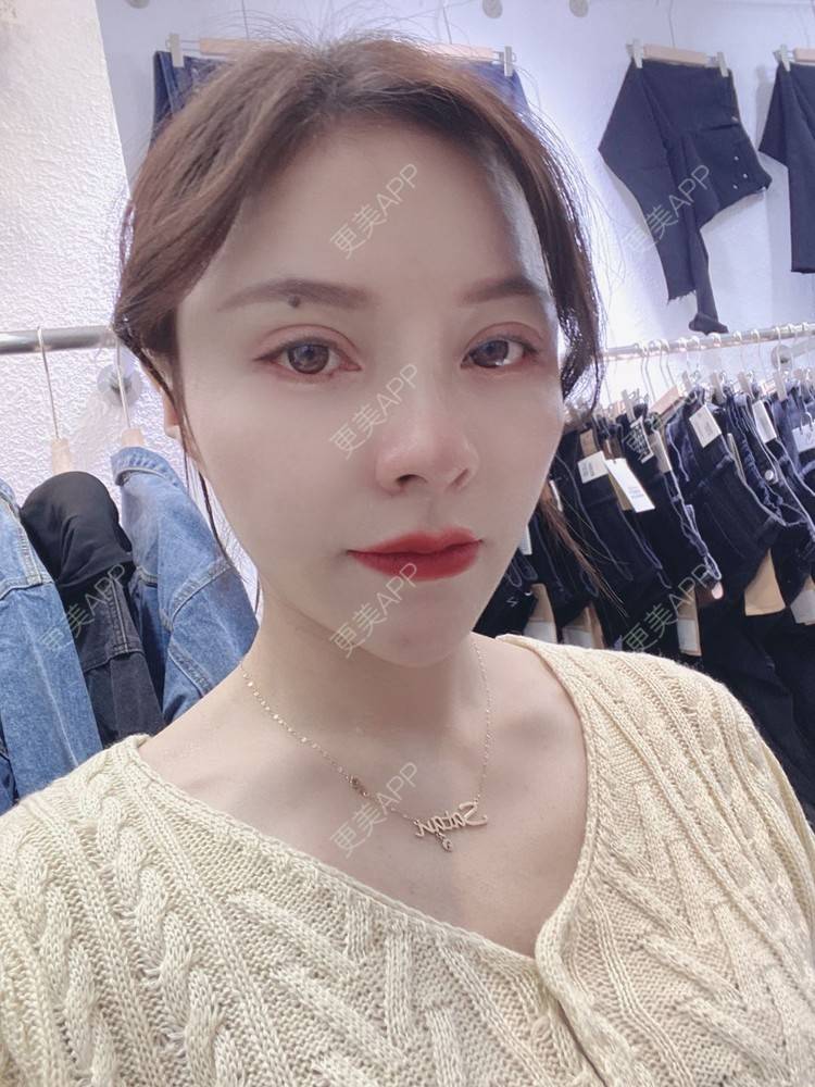 更美 - 更美用户cYoCneHuFl的鼻部多项经验 | 阳江 | 鼻部多项