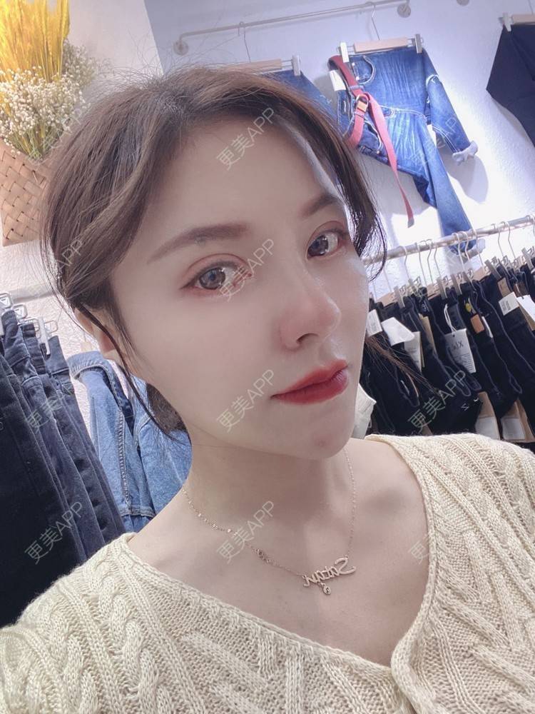 更美 - 更美用户cYoCneHuFl的鼻部多项经验 | 阳江 | 鼻部多项