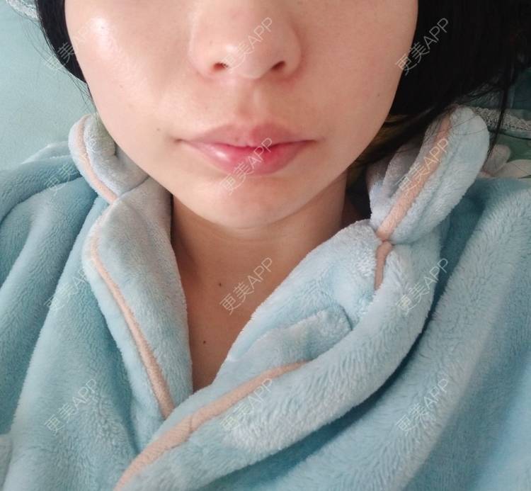 更美 - 更美用户33jmvOkmJt的玻尿酸下巴经验 | 玻尿酸下巴 | 重庆