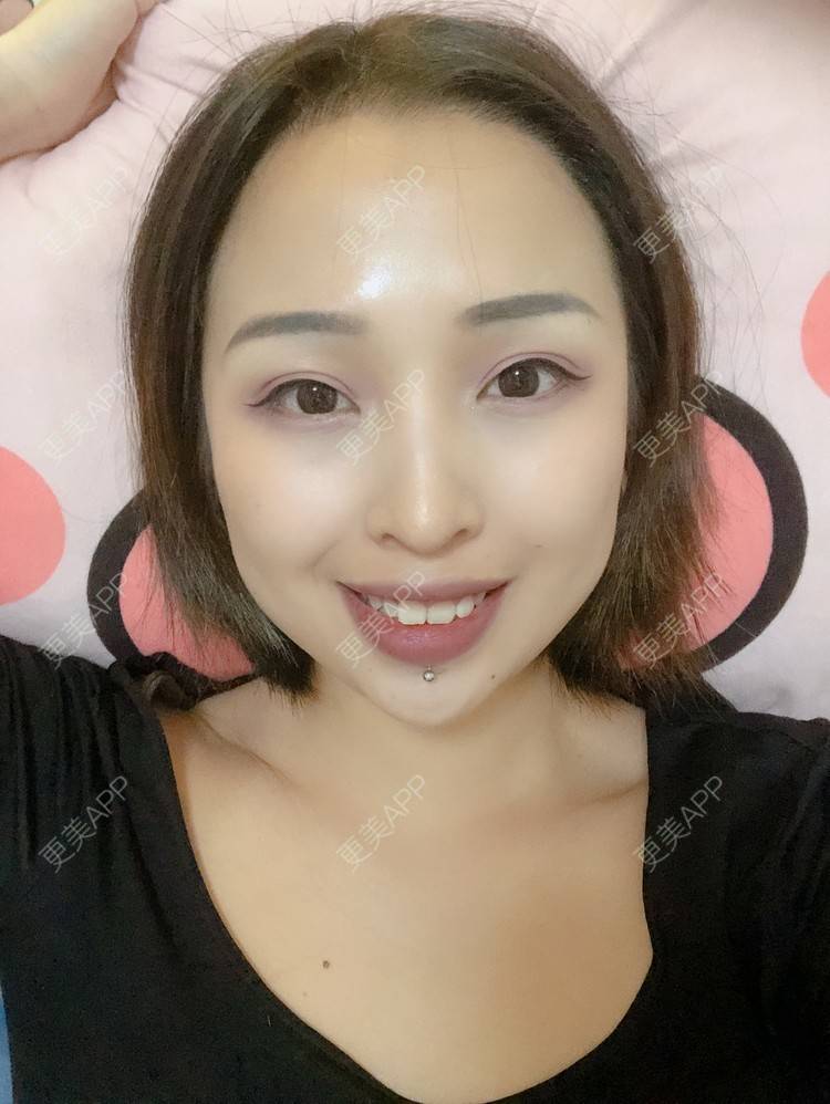 更美 - 更美用户P19XxFFfBr的植发际线经验 | 头顶加密种植 | 植发际线 | 成都