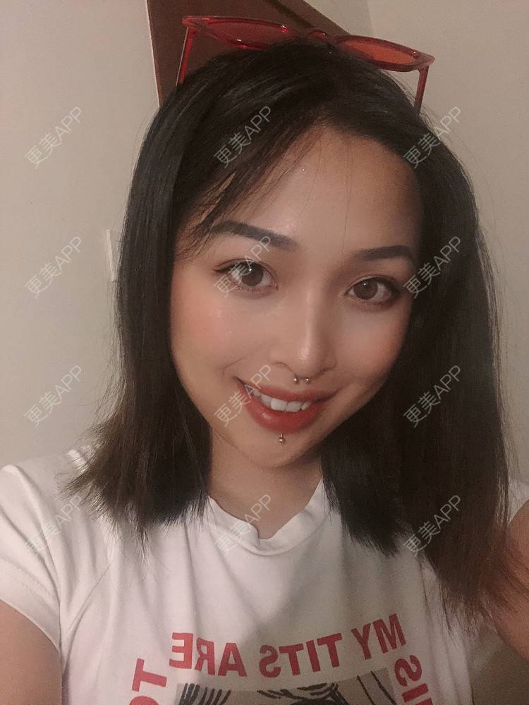 更美 - 更美用户P19XxFFfBr的植发际线经验 | 头顶加密种植 | 植发际线 | 成都