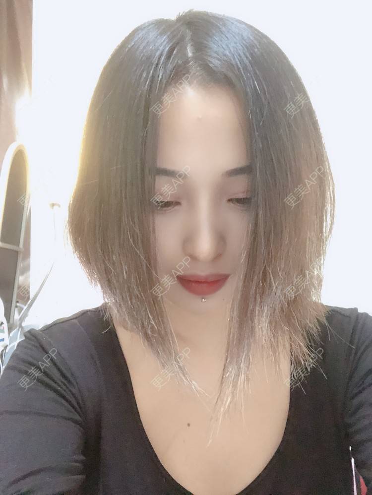 更美 - 更美用户P19XxFFfBr的植发际线经验 | 头顶加密种植 | 植发际线 | 成都