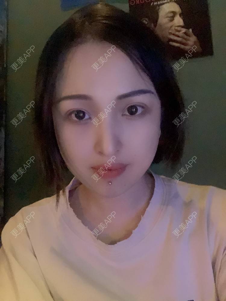 更美 - 更美用户P19XxFFfBr的植发际线经验 | 头顶加密种植 | 植发际线 | 成都