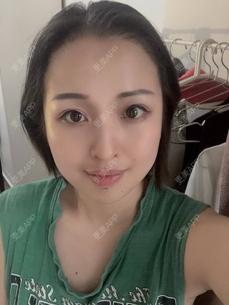 更美 - 更美用户P19XxFFfBr的植发际线经验 | 头顶加密种植 | 植发际线 | 成都