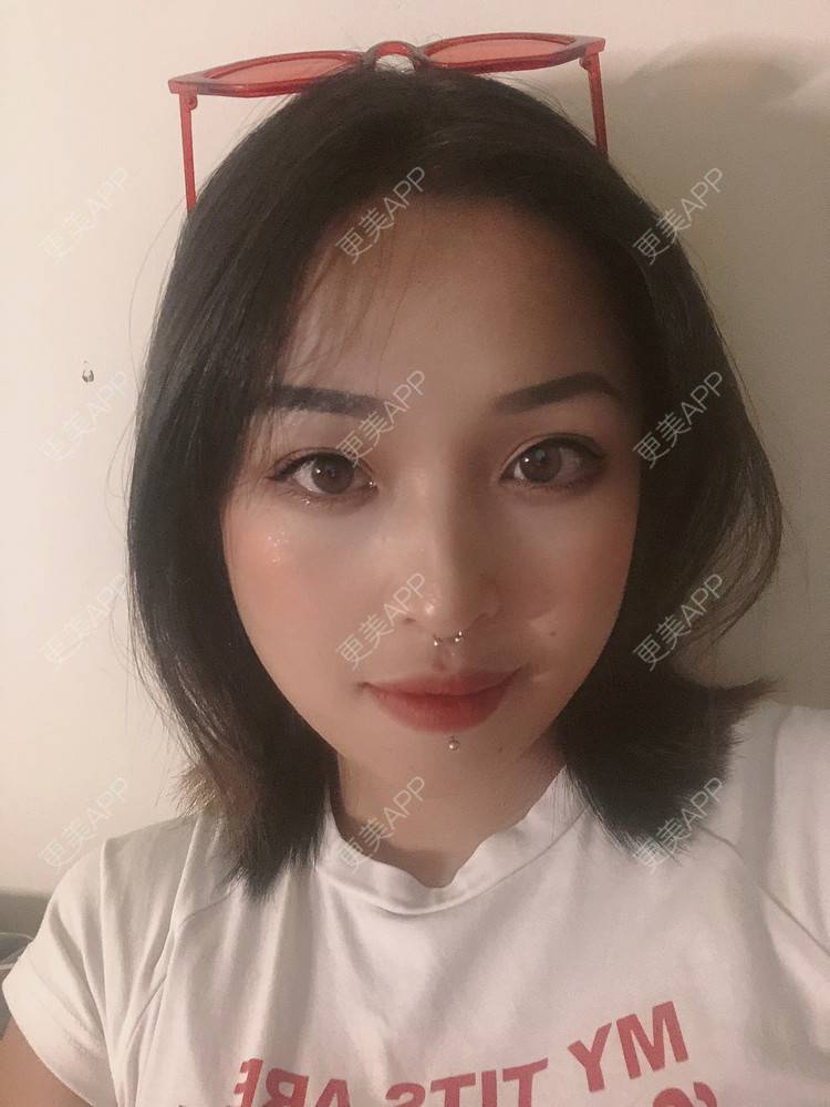 更美 - 更美用户P19XxFFfBr的植发际线经验 | 头顶加密种植 | 植发际线 | 成都