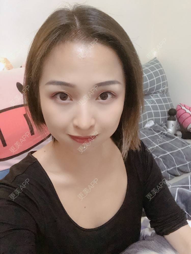 更美 - 更美用户P19XxFFfBr的植发际线经验 | 头顶加密种植 | 植发际线 | 成都