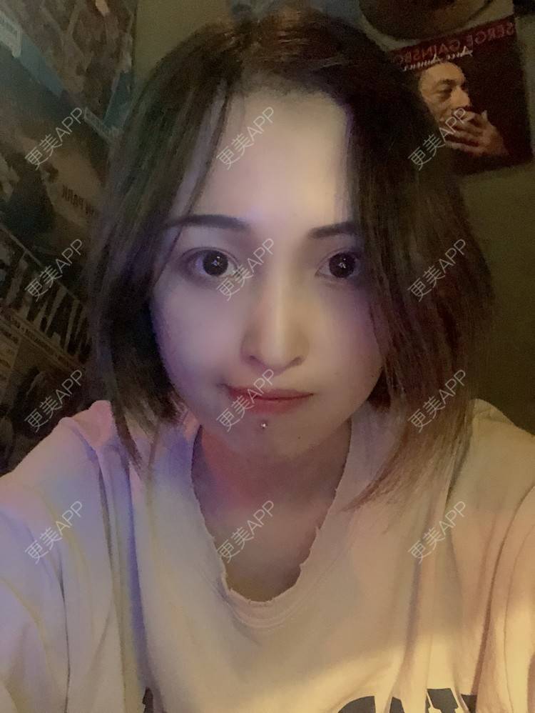 更美 - 更美用户P19XxFFfBr的植发际线经验 | 头顶加密种植 | 植发际线 | 成都