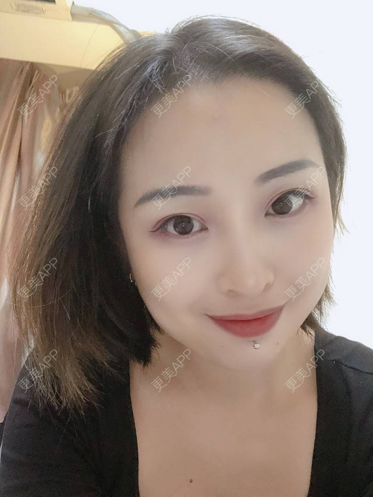 更美 - 更美用户P19XxFFfBr的植发际线经验 | 头顶加密种植 | 植发际线 | 成都