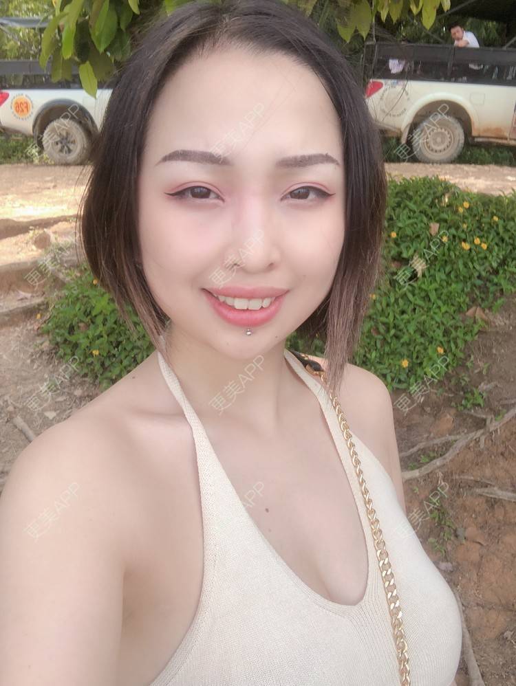 更美 - 更美用户P19XxFFfBr的植发际线经验 | 头顶加密种植 | 植发际线 | 成都