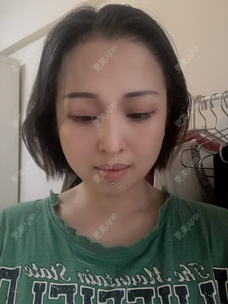 更美 - 更美用户P19XxFFfBr的植发际线经验 | 头顶加密种植 | 植发际线 | 成都