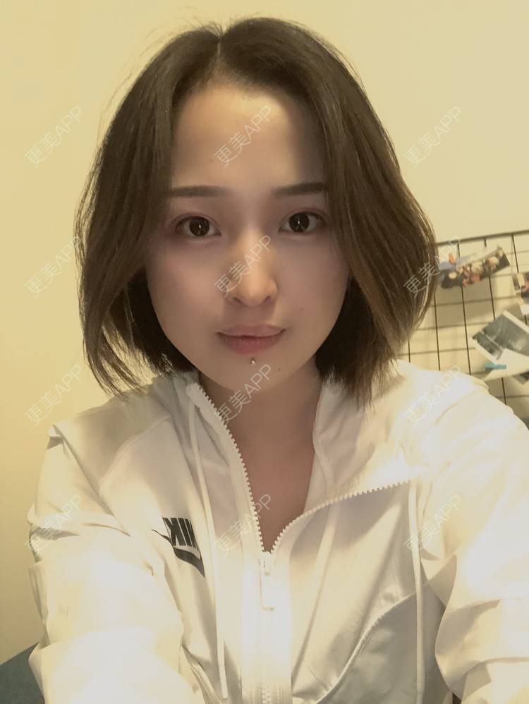 更美 - 更美用户P19XxFFfBr的植发际线经验 | 头顶加密种植 | 植发际线 | 成都