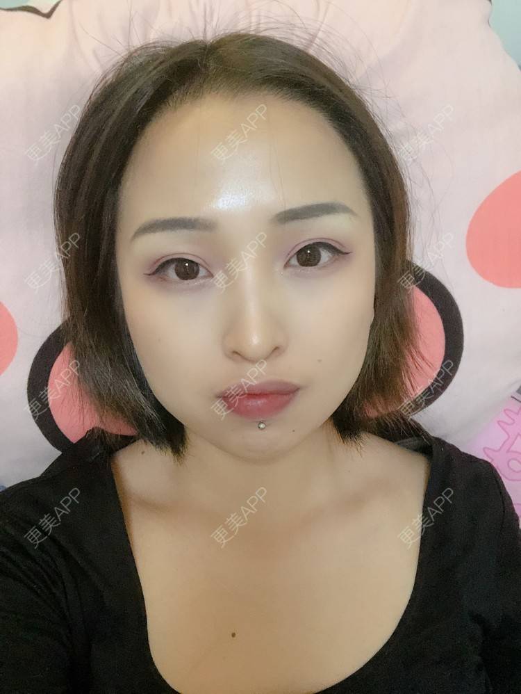 更美 - 更美用户P19XxFFfBr的植发际线经验 | 头顶加密种植 | 植发际线 | 成都