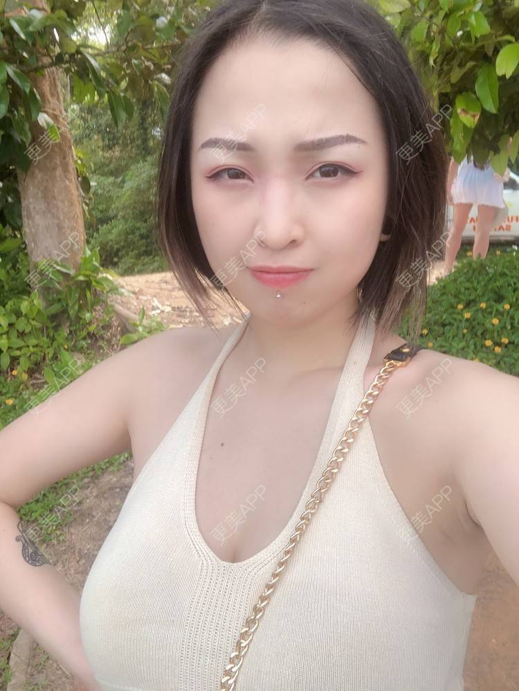 更美 - 更美用户P19XxFFfBr的植发际线经验 | 头顶加密种植 | 植发际线 | 成都