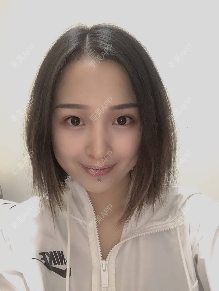 更美 - 更美用户P19XxFFfBr的植发际线经验 | 头顶加密种植 | 植发际线 | 成都