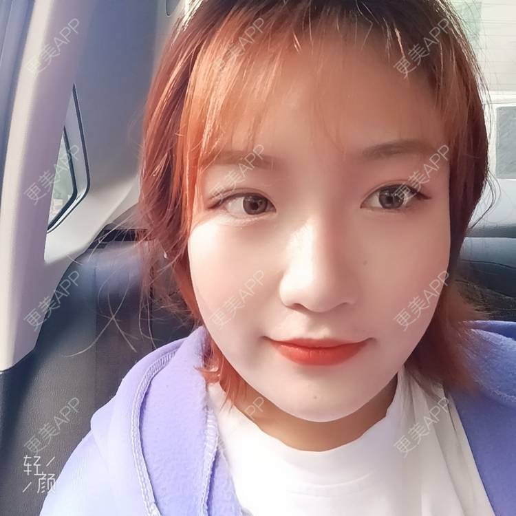 更美 - 更美用户tbs28rKiLZ的定点双眼皮经验 | 定点双眼皮 | 杭州