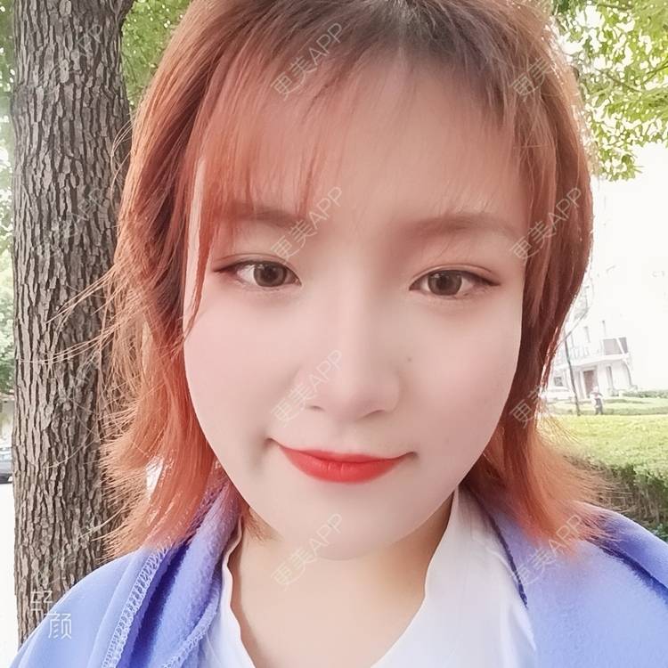 更美 - 更美用户tbs28rKiLZ的定点双眼皮经验 | 定点双眼皮 | 杭州