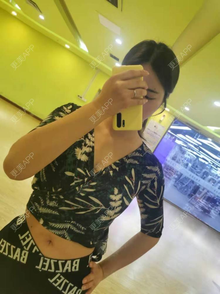 更美 - 更美用户5vlsyvcRWF的肩部吸脂经验 | 视频日记 | 北京 | 肩部吸脂 | 腰部吸脂 | 腹部吸脂