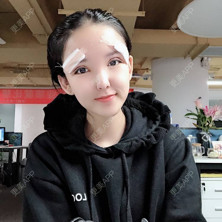 更美 - 大哲❤️的双眼皮修复经验 | 双眼皮修复 | 重庆