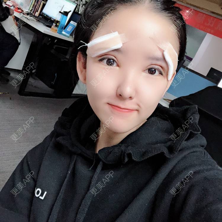 更美 - 大哲❤️的双眼皮修复经验 | 双眼皮修复 | 重庆
