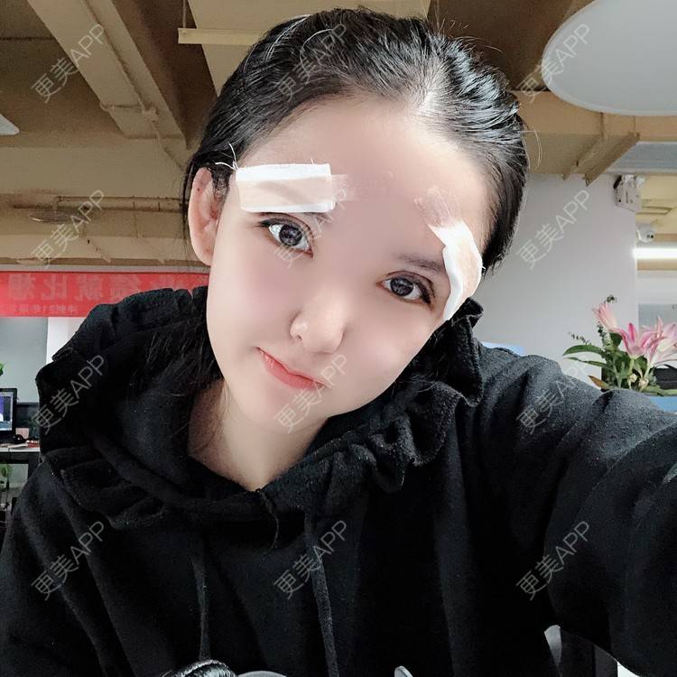 更美 - 大哲❤️的双眼皮修复经验 | 双眼皮修复 | 重庆