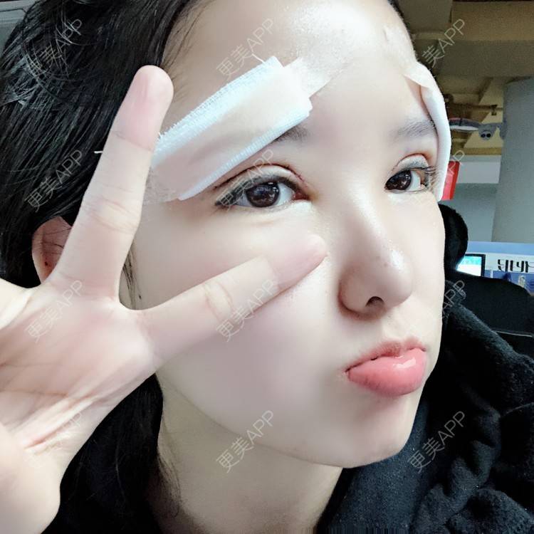 更美 - 大哲❤️的双眼皮修复经验 | 双眼皮修复 | 重庆
