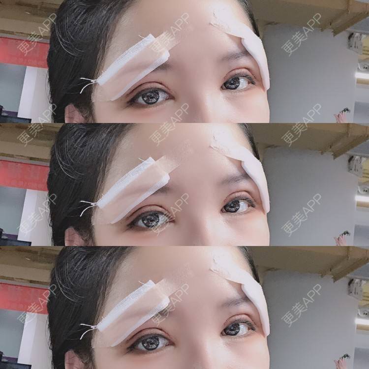 更美 - 大哲❤️的双眼皮修复经验 | 双眼皮修复 | 重庆