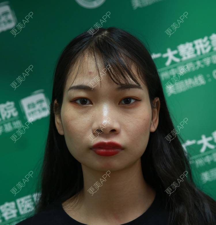 更美 - 萍萍姐呀的凸嘴矫正经验 | 凸嘴矫正 | 广州