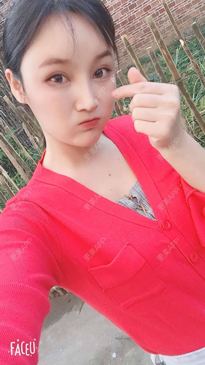 更美 - 青柠味的夏天的隆鼻经验 | 广州 | 隆鼻