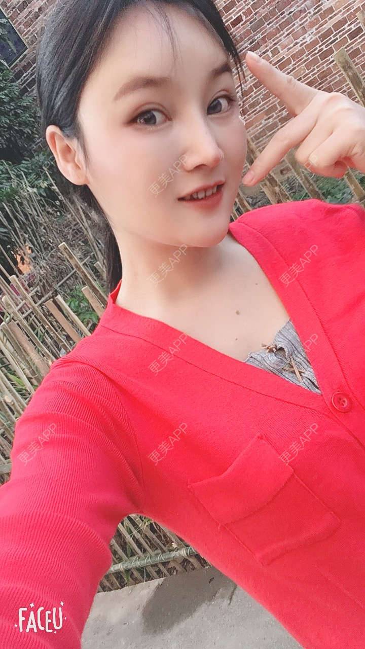 更美 - 青柠味的夏天的隆鼻经验 | 广州 | 隆鼻