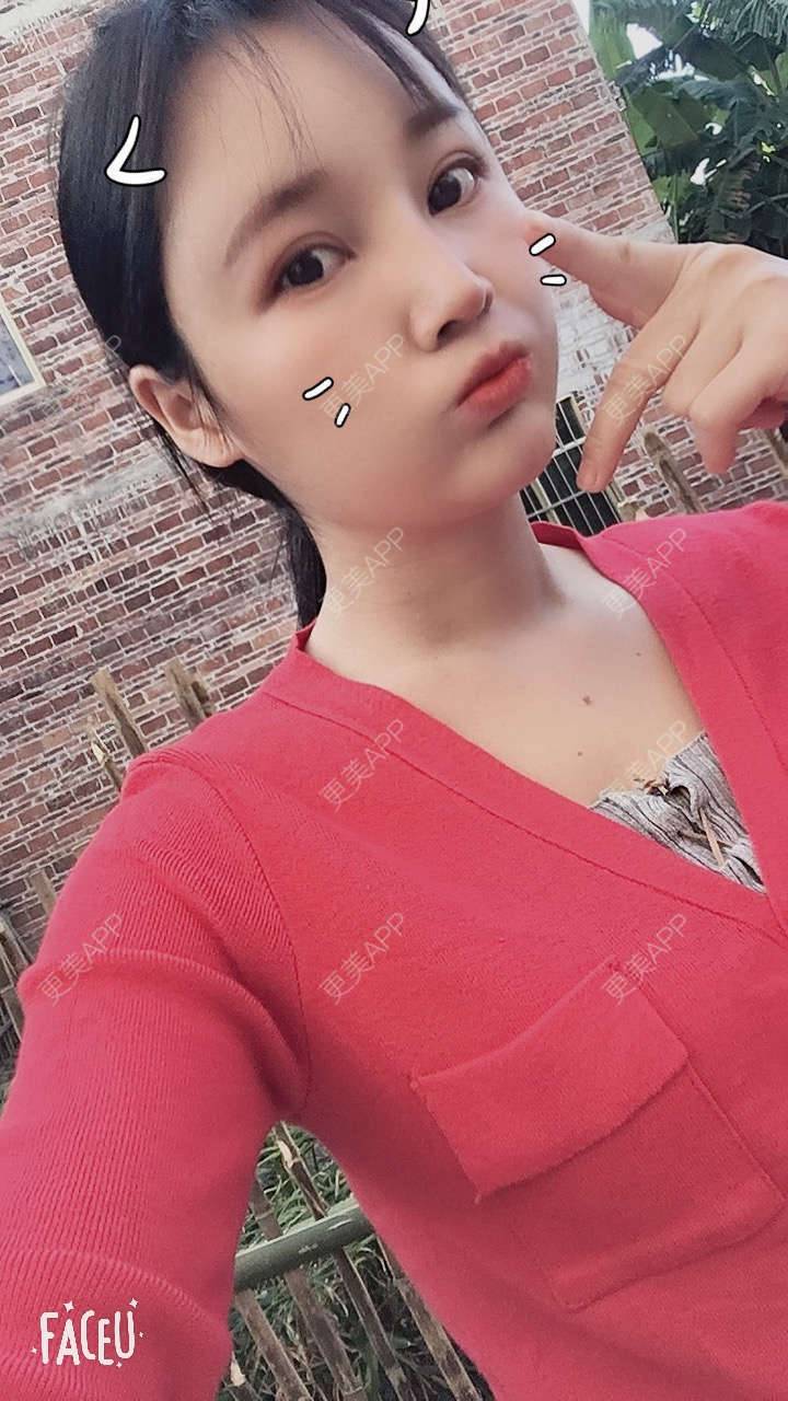 更美 - 青柠味的夏天的隆鼻经验 | 广州 | 隆鼻