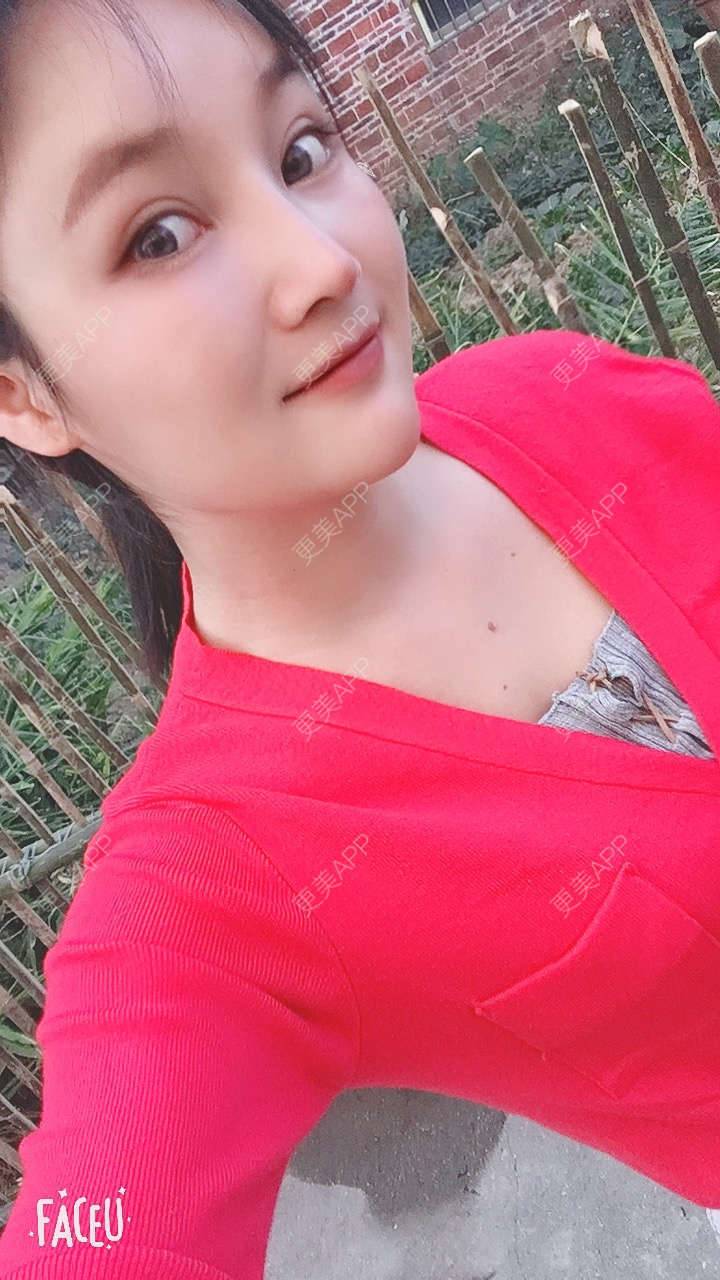 更美 - 青柠味的夏天的隆鼻经验 | 广州 | 隆鼻