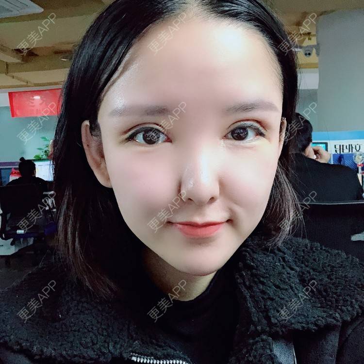 更美 - 大哲❤️的双眼皮修复经验 | 双眼皮修复 | 重庆