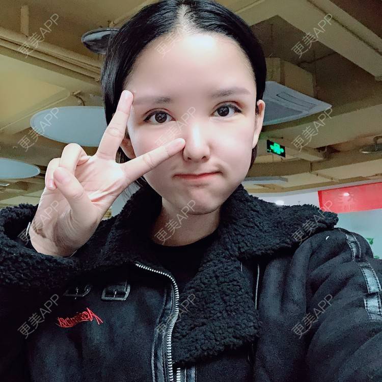 更美 - 大哲❤️的双眼皮修复经验 | 双眼皮修复 | 重庆