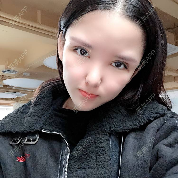 更美 - 大哲❤️的双眼皮修复经验 | 双眼皮修复 | 重庆