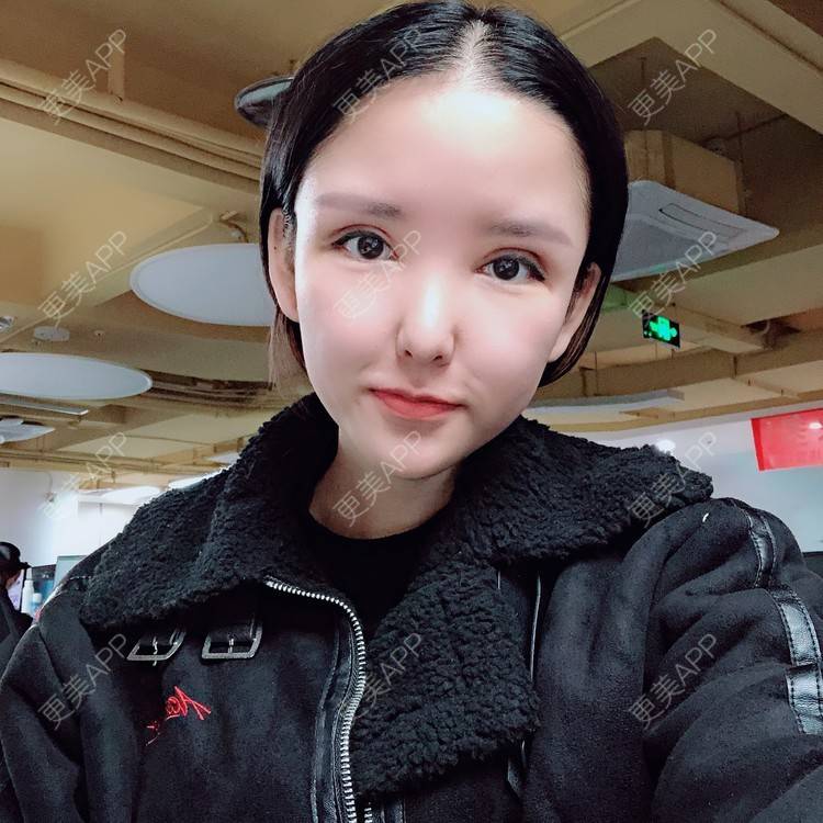 更美 - 大哲❤️的双眼皮修复经验 | 双眼皮修复 | 重庆