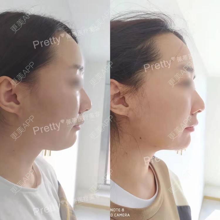 更美 - 昆明佩蒂医疗美容的双下巴吸脂经验 | 双下巴吸脂
