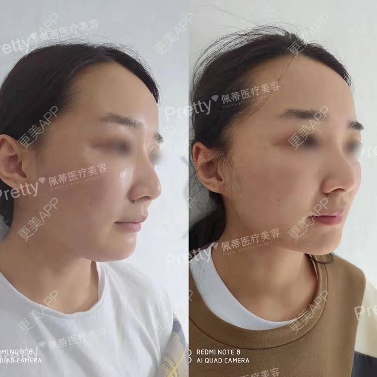 更美 - 昆明佩蒂医疗美容的双下巴吸脂经验 | 双下巴吸脂
