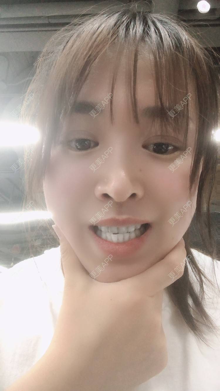 更美 - 更美用户nOSa2OXrxm的冷光美白经验 | 北京 | 冷光美白