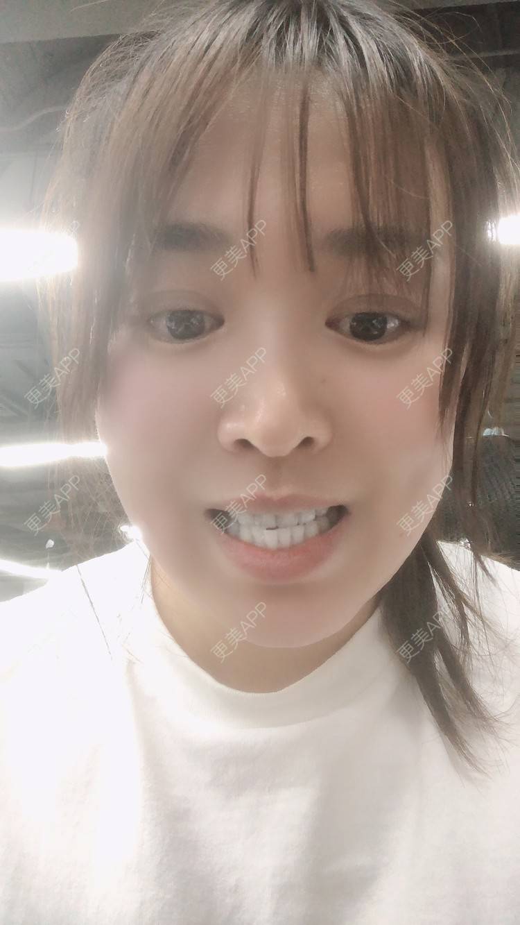 更美 - 更美用户nOSa2OXrxm的冷光美白经验 | 北京 | 冷光美白