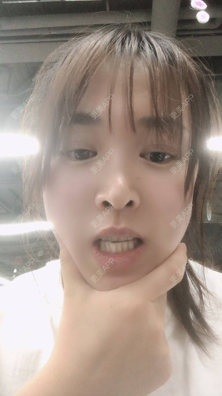 更美 - 更美用户nOSa2OXrxm的冷光美白经验 | 北京 | 冷光美白
