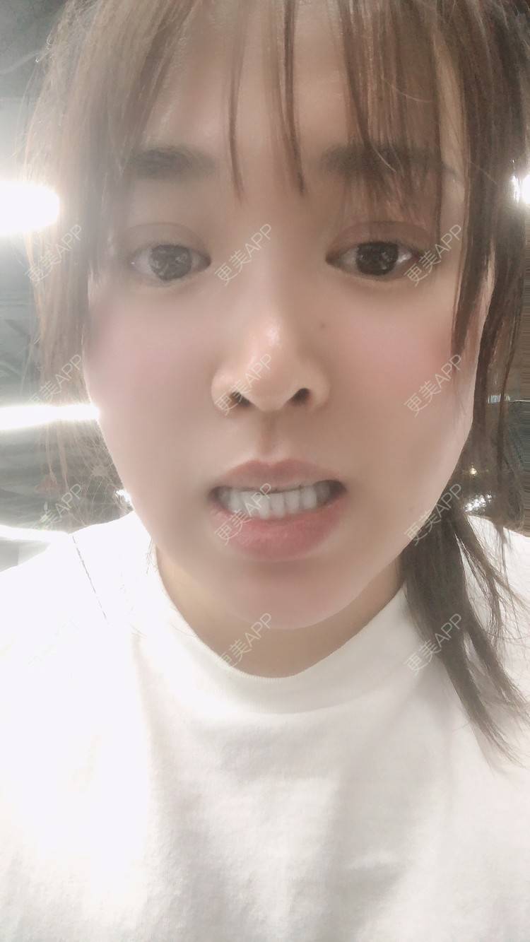 更美 - 更美用户nOSa2OXrxm的冷光美白经验 | 北京 | 冷光美白