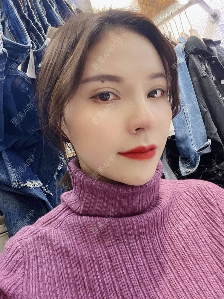 更美 - 更美用户cYoCneHuFl的鼻部多项经验 | 阳江 | 鼻部多项