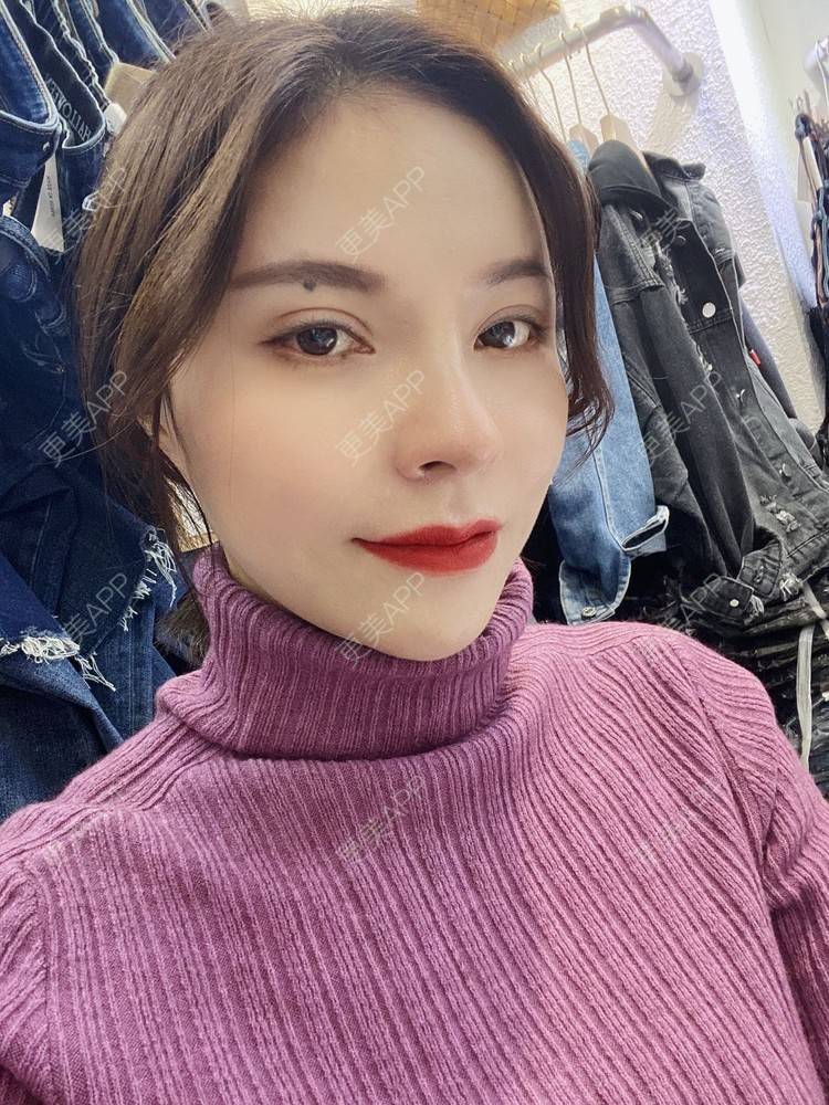 更美 - 更美用户cYoCneHuFl的鼻部多项经验 | 阳江 | 鼻部多项