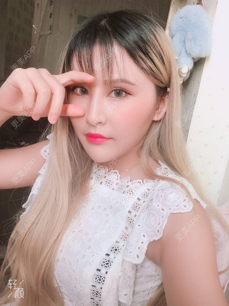 更美 - 阿依古丽💫的全切双眼皮经验 | 视频日记 | 全切双眼皮 | 重庆