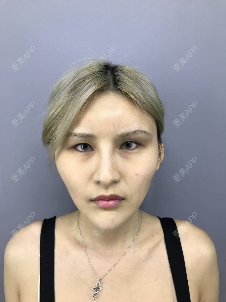 更美 - 阿依古丽💫的全切双眼皮经验 | 视频日记 | 全切双眼皮 | 重庆