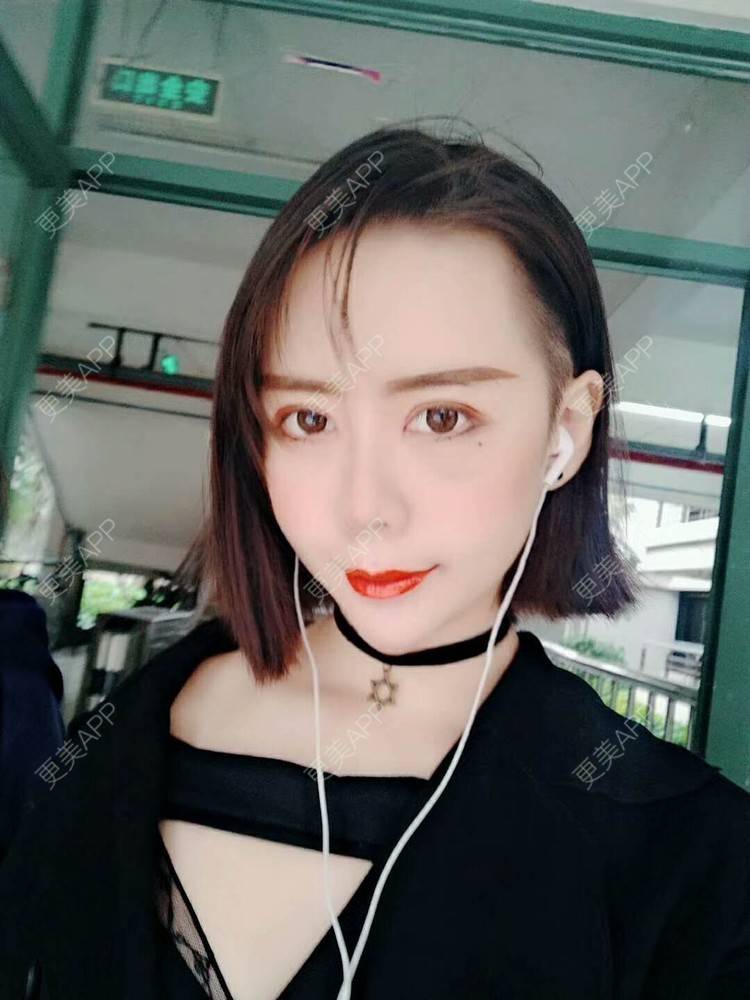 更美 - 哑琳的自体脂肪丰苹果肌经验 | 自体脂肪丰苹果肌 | 自体脂肪垫下巴 | 自体脂肪丰额头 | 自体脂肪填充法令纹 | 深圳 | 自体脂肪全面部填充