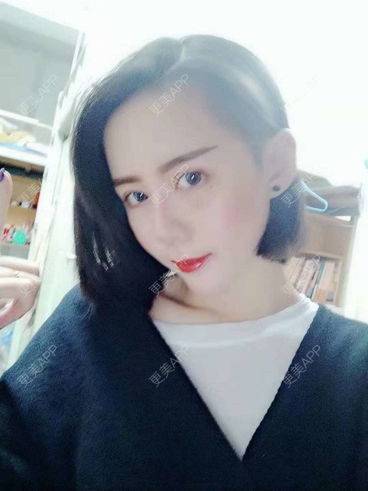 更美 - 哑琳的自体脂肪丰苹果肌经验 | 自体脂肪丰苹果肌 | 自体脂肪垫下巴 | 自体脂肪丰额头 | 自体脂肪填充法令纹 | 深圳 | 自体脂肪全面部填充