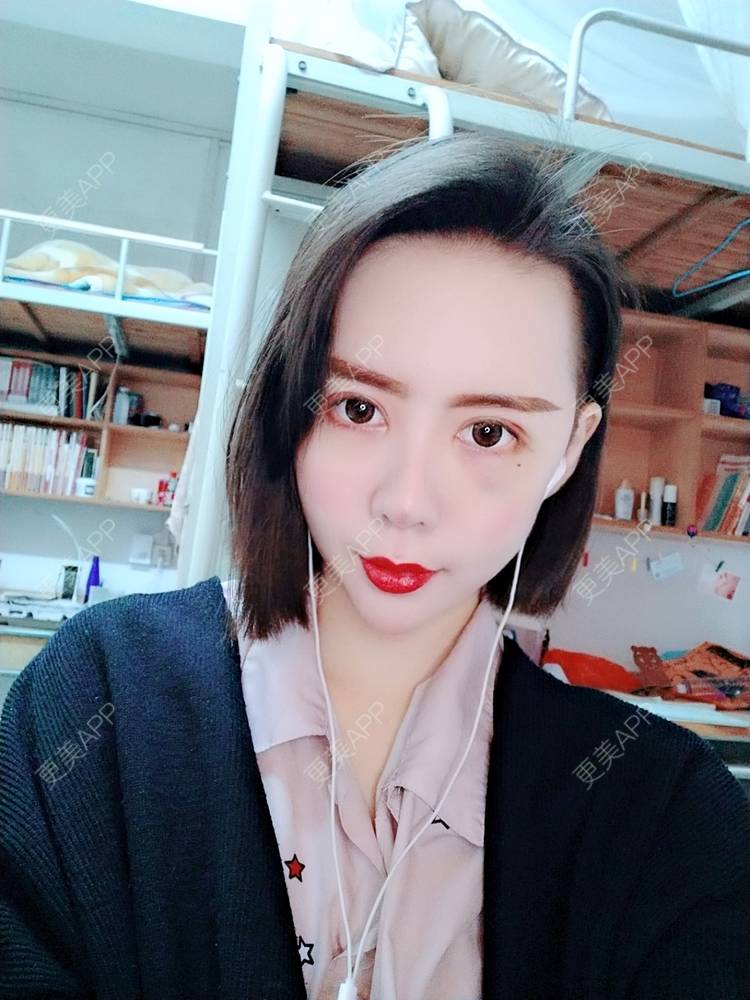 更美 - 哑琳的自体脂肪丰苹果肌经验 | 自体脂肪丰苹果肌 | 自体脂肪垫下巴 | 自体脂肪丰额头 | 自体脂肪填充法令纹 | 深圳 | 自体脂肪全面部填充