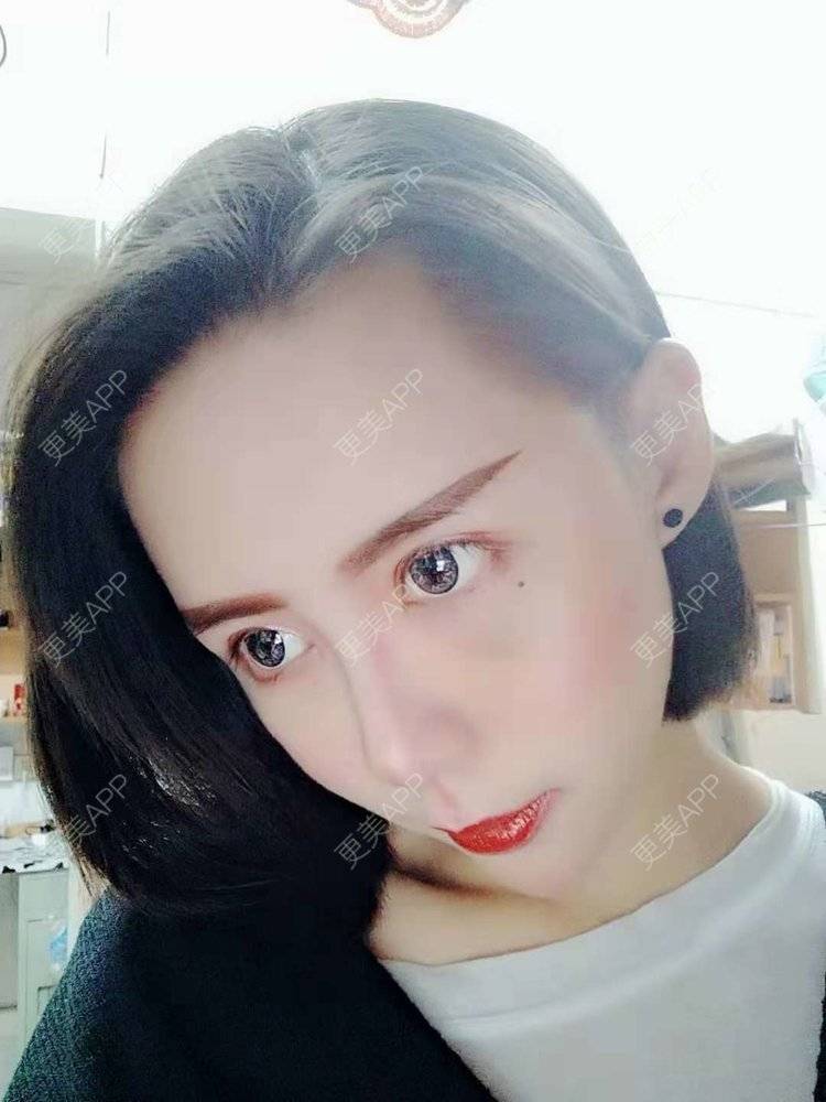 更美 - 哑琳的自体脂肪丰苹果肌经验 | 自体脂肪丰苹果肌 | 自体脂肪垫下巴 | 自体脂肪丰额头 | 自体脂肪填充法令纹 | 深圳 | 自体脂肪全面部填充